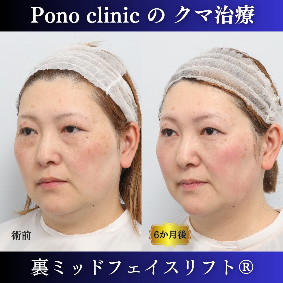 裏ミッドフェイスリフト®、骨膜下リフト、目の下のクマ取り、40代の症例 (3)