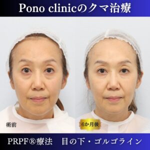目の下のクマ取り注射、目の下のたるみ、黒クマ、PRPF®療法、切らないクマ治療、60代の症例 (6)