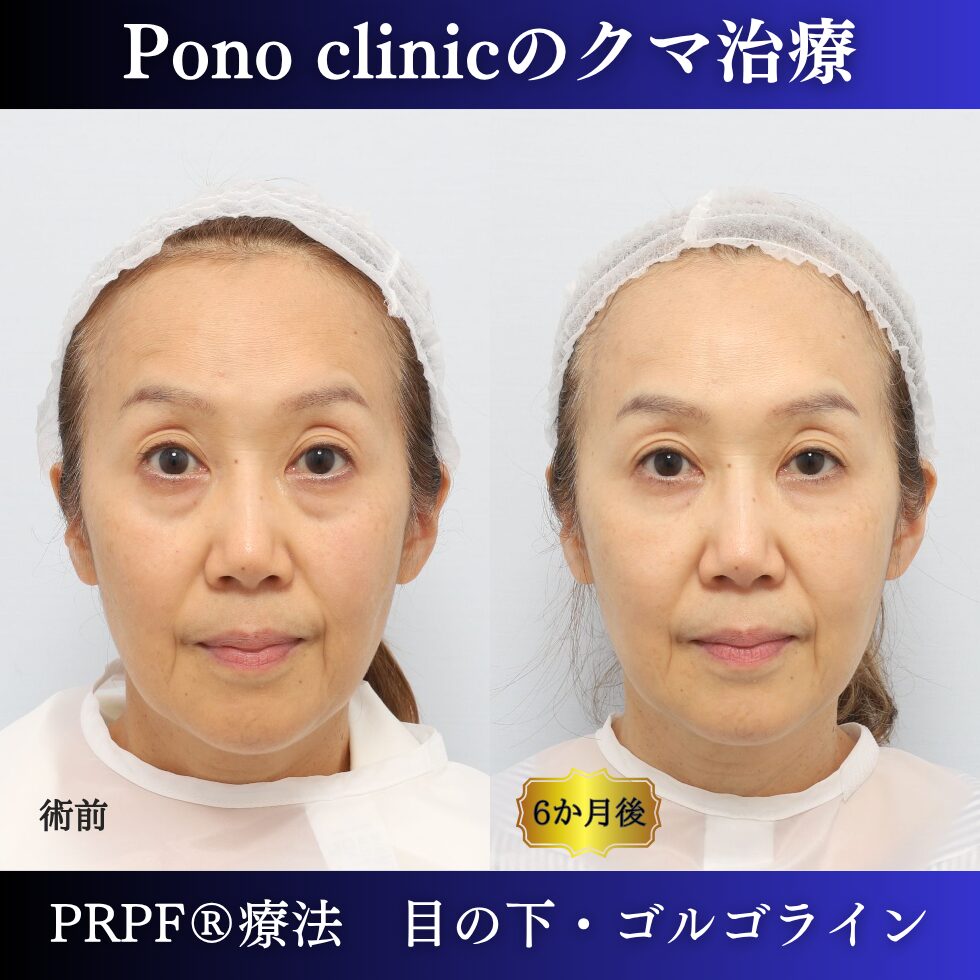 目の下のクマ取り注射、目の下のたるみ、黒クマ、PRPF®療法、切らないクマ治療、60代の症例 (6)