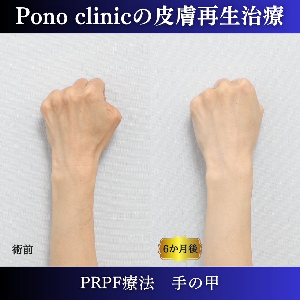 手の甲の若返り、手ののゴツゴツ、PRPF療法 、40代の症例 (1)