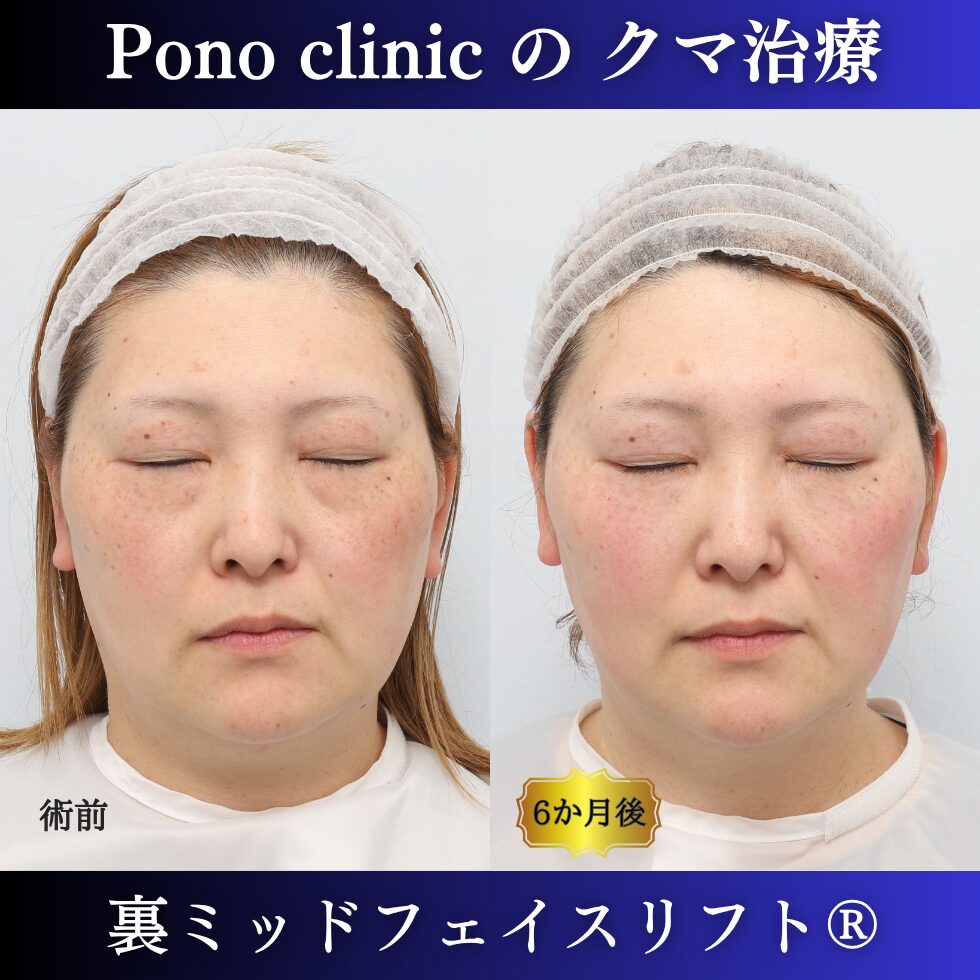 裏ミッドフェイスリフト®、骨膜下リフト、目の下のクマ取り、40代の症例 (5)