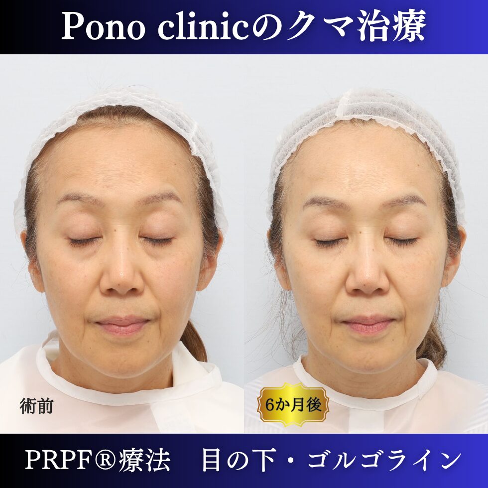 目の下のクマ取り注射、目の下のたるみ、黒クマ、PRPF®療法、切らないクマ治療、60代の症例 (5)