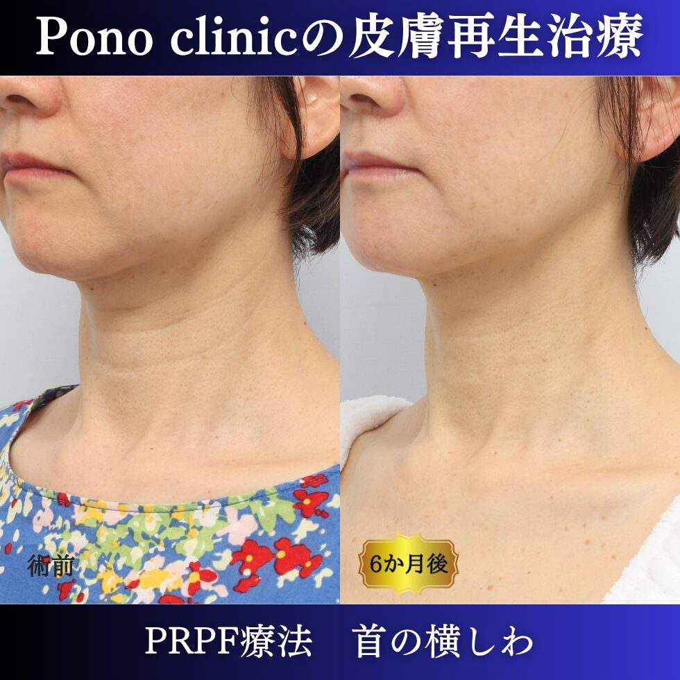 首のシワ、しわ治療、 50代の症例 (4)