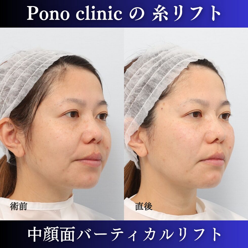 中顔面バーティカルリフト、糸リフト、リフトアップ、40代の症例 (1)