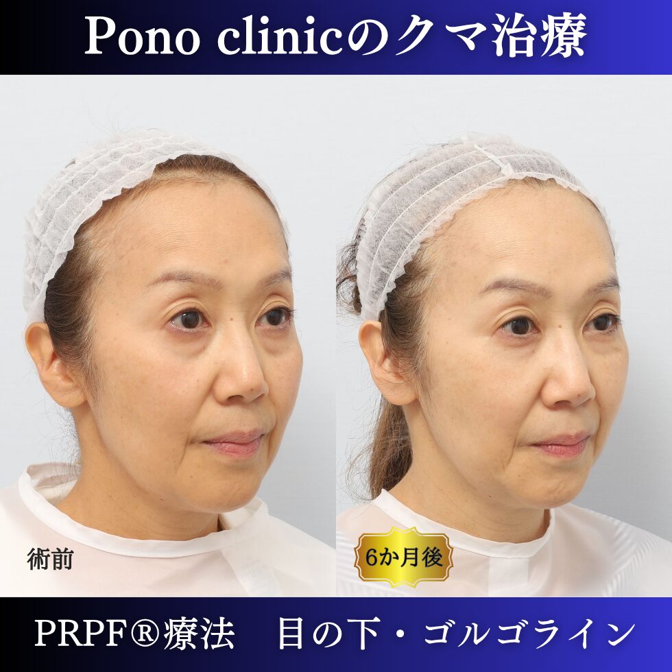 目の下のクマ取り注射、目の下のたるみ、黒クマ、PRPF®療法、切らないクマ治療、60代の症例 (1)