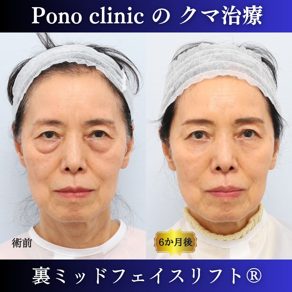 目の下のクマ、目の下のたるみ、裏ミッドフェイスリフト、70代の症例 (3)