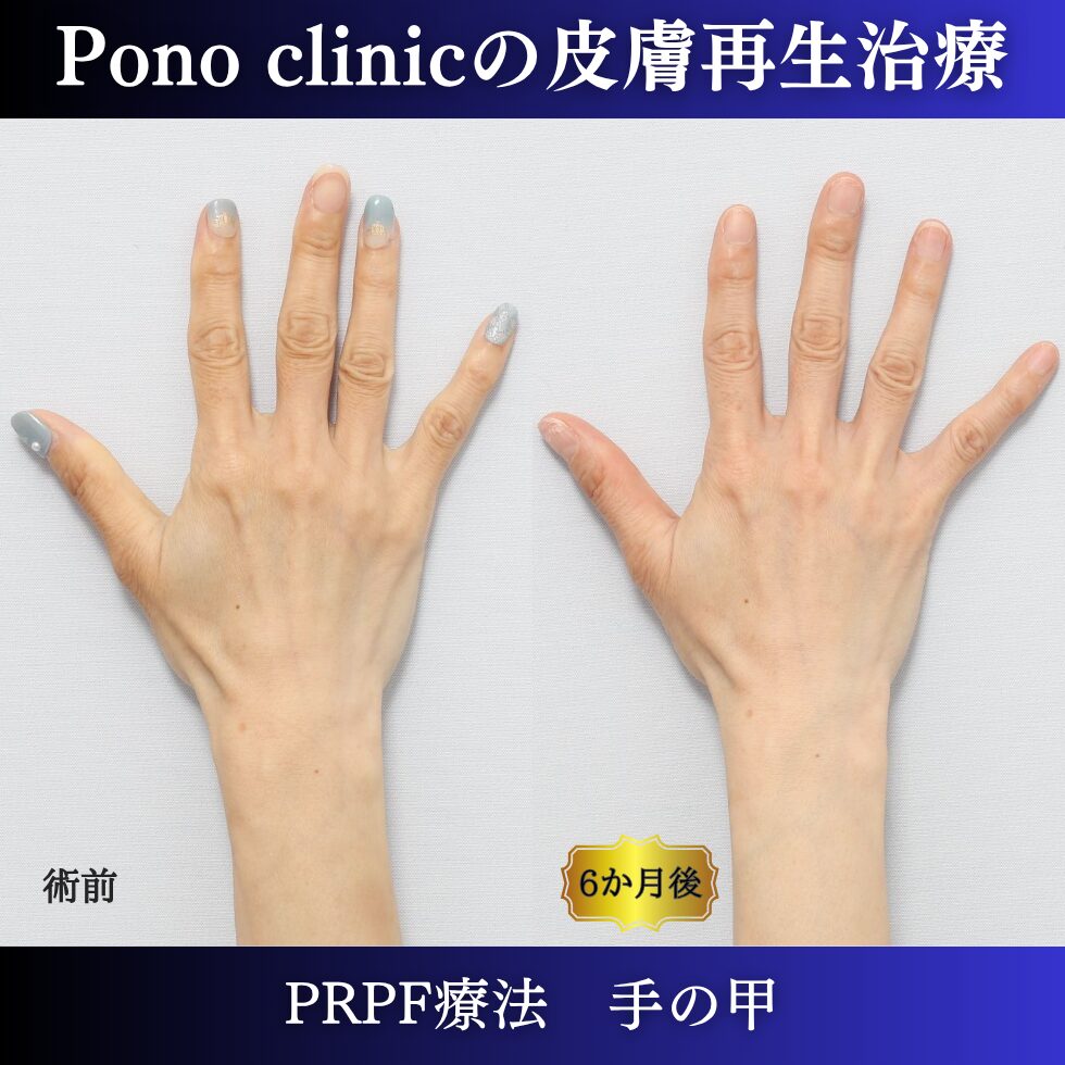手の甲の若返り、手ののゴツゴツ、PRPF療法 、40代の症例 (4)