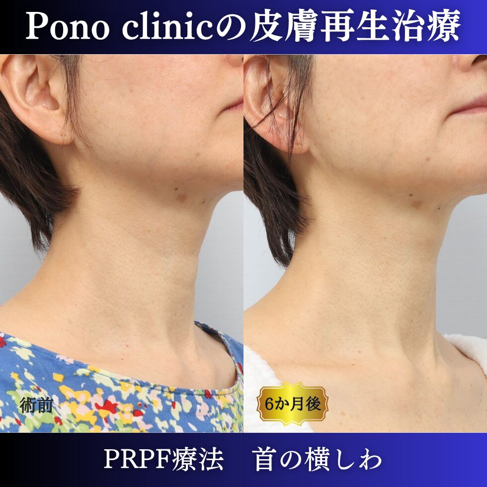 首のシワ、しわ治療、 50代の症例 (1)