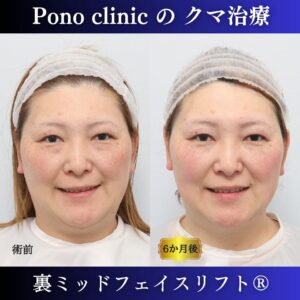 裏ミッドフェイスリフト®、骨膜下リフト、目の下のクマ取り、40代の症例 (6)