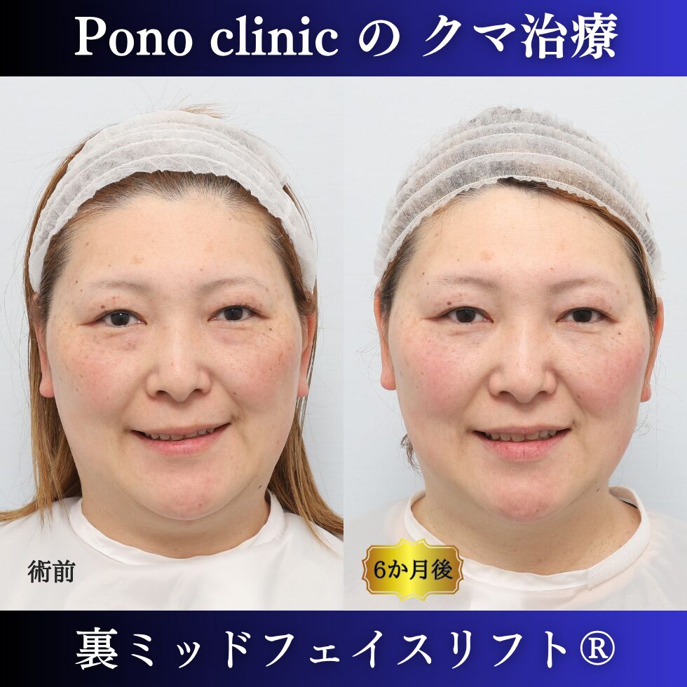 裏ミッドフェイスリフト®、骨膜下リフト、目の下のクマ取り、40代の症例 (6)