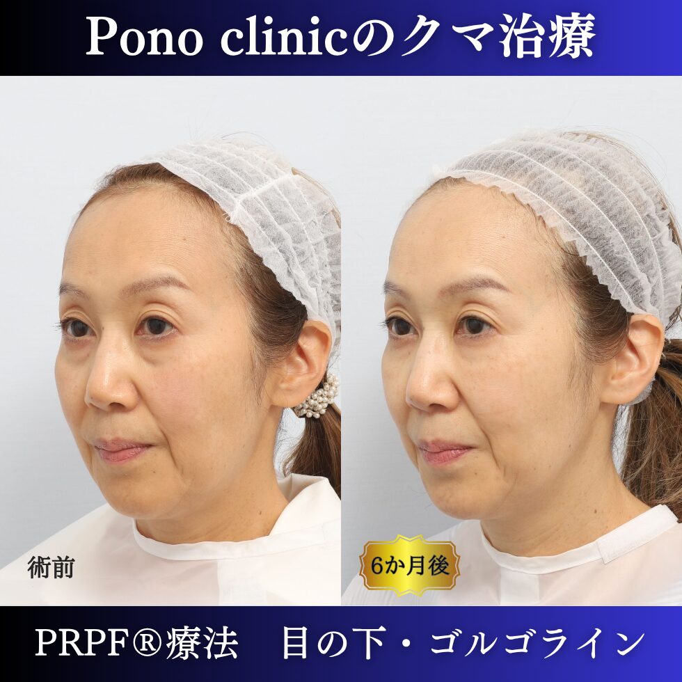 目の下のクマ取り注射、目の下のたるみ、黒クマ、PRPF®療法、切らないクマ治療、60代の症例 (2)