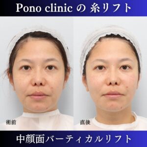 中顔面バーティカルリフト、糸リフト、リフトアップ、40代の症例 (4)