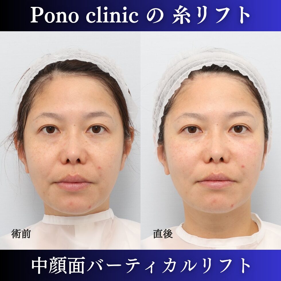 中顔面バーティカルリフト、糸リフト、リフトアップ、40代の症例 (4)