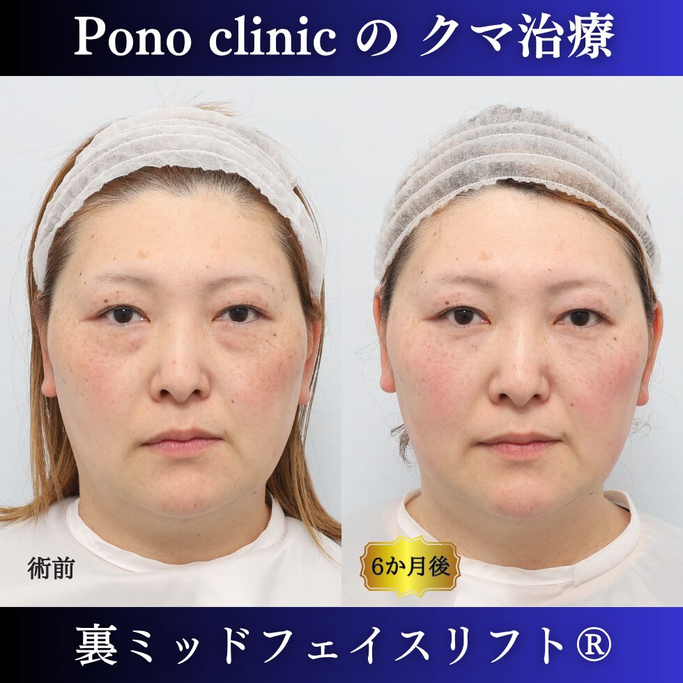 裏ミッドフェイスリフト®、骨膜下リフト、目の下のクマ取り、40代の症例 (7)