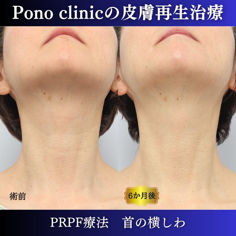 首のシワ、しわ治療、 50代の症例 (5)