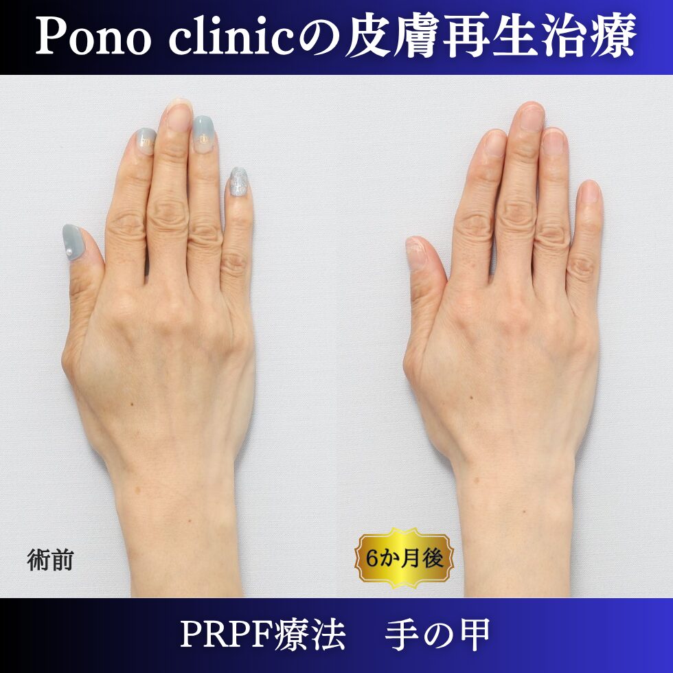 手の甲の若返り、手ののゴツゴツ、PRPF療法 、40代の症例 (6)