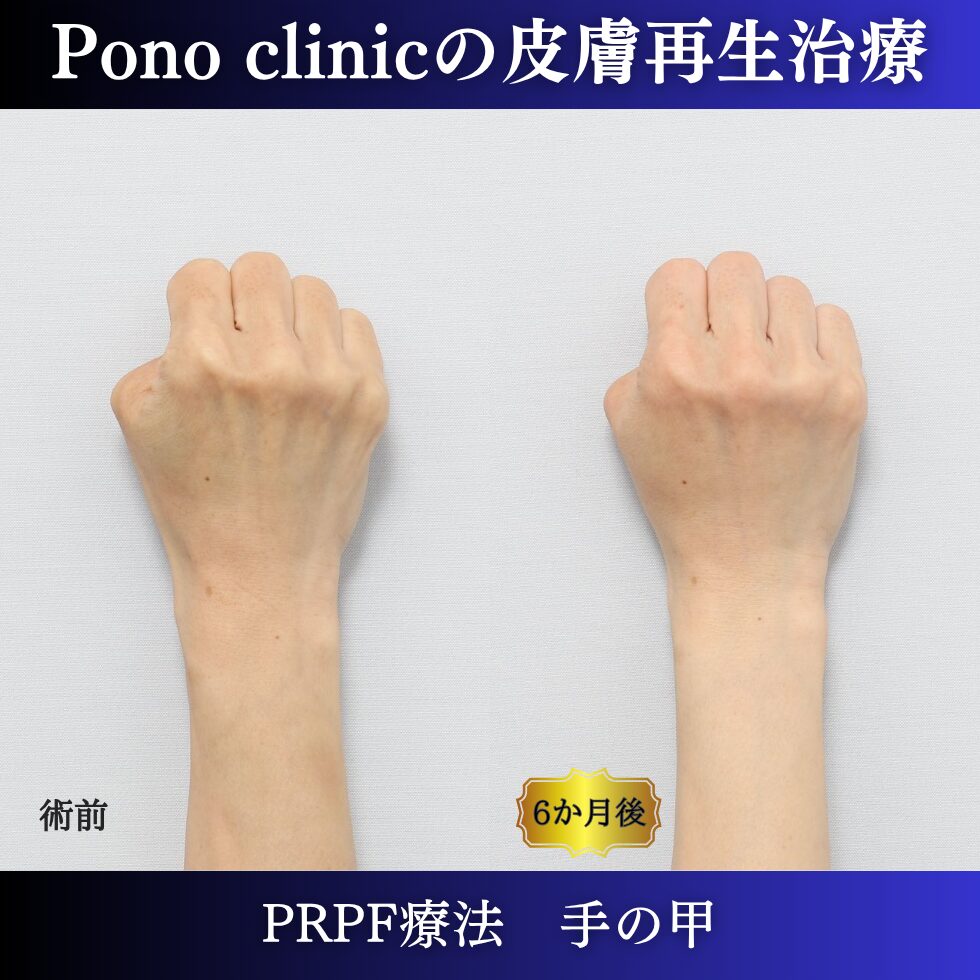 手の甲の若返り、手ののゴツゴツ、PRPF療法 、40代の症例 (5)