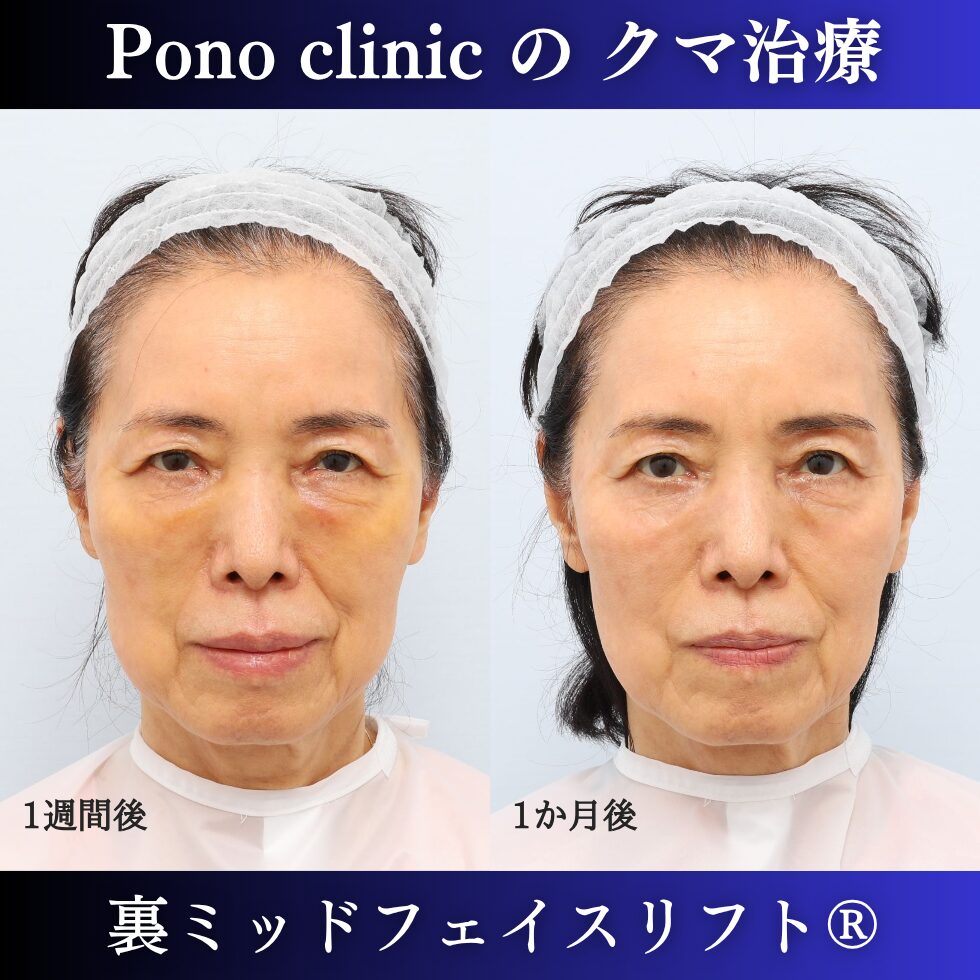 目の下のクマ、目の下のたるみ、裏ミッドフェイスリフト、70代の症例 (4)