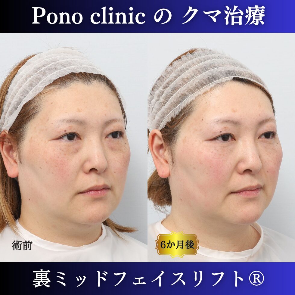 裏ミッドフェイスリフト®、骨膜下リフト、目の下のクマ取り、40代の症例 (2)