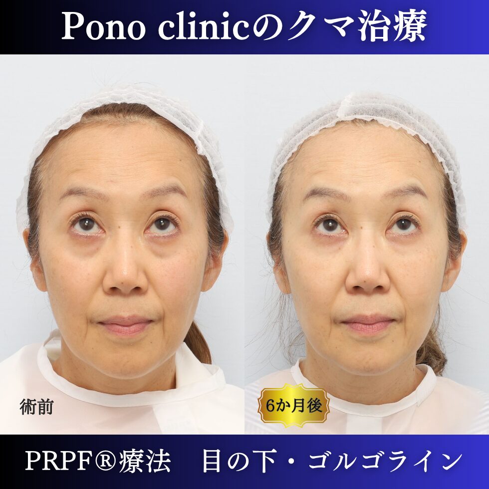目の下のクマ取り注射、目の下のたるみ、黒クマ、PRPF®療法、切らないクマ治療、60代の症例 (4)