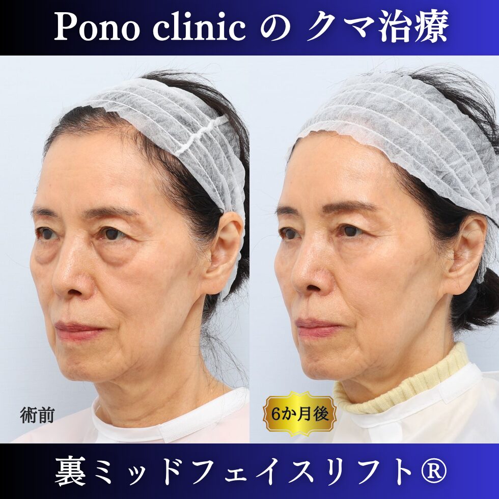 目の下のクマ、目の下のたるみ、裏ミッドフェイスリフト、70代の症例 (2)
