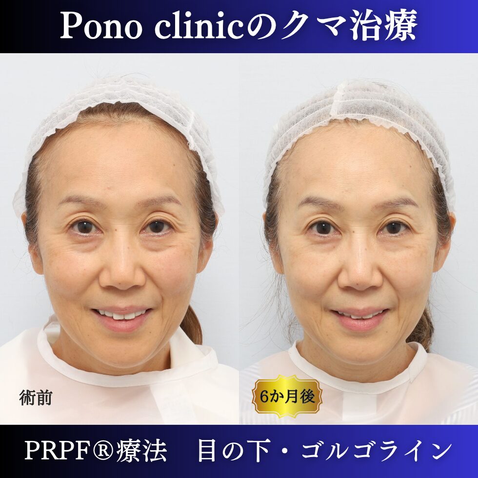 目の下のクマ取り注射、目の下のたるみ、黒クマ、PRPF®療法、切らないクマ治療、60代の症例 (3)