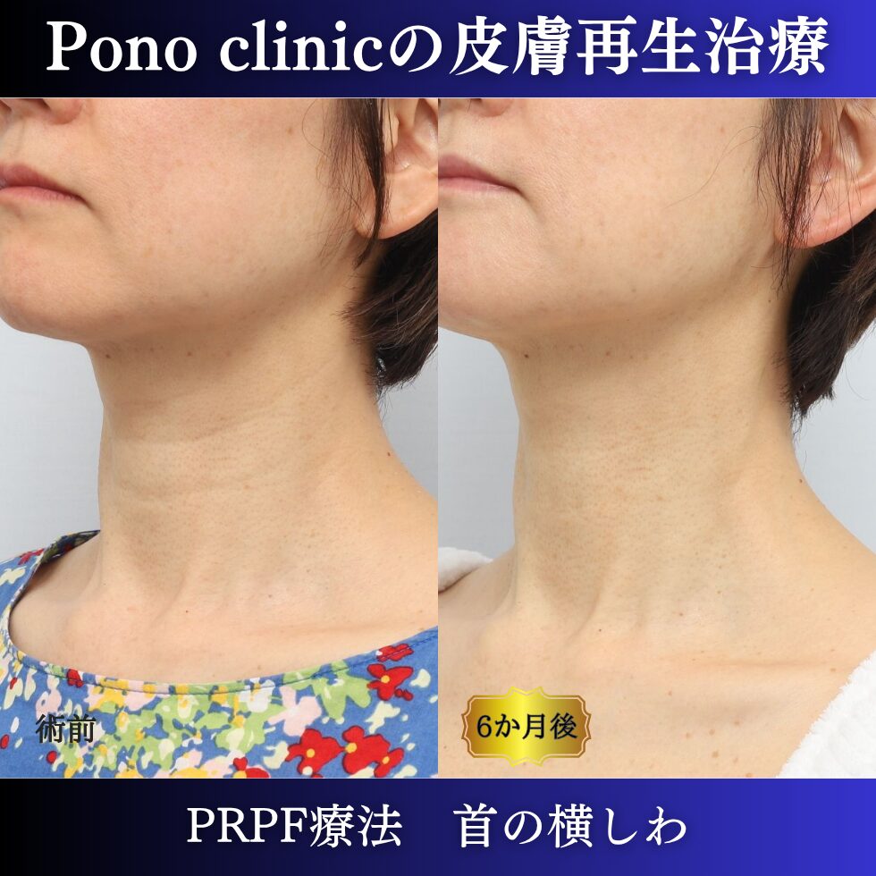 首のシワ、しわ治療、 50代の症例 (3)