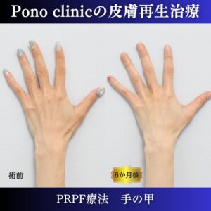 手の甲の若返り、手ののゴツゴツ、PRPF療法 、40代の症例 (3)