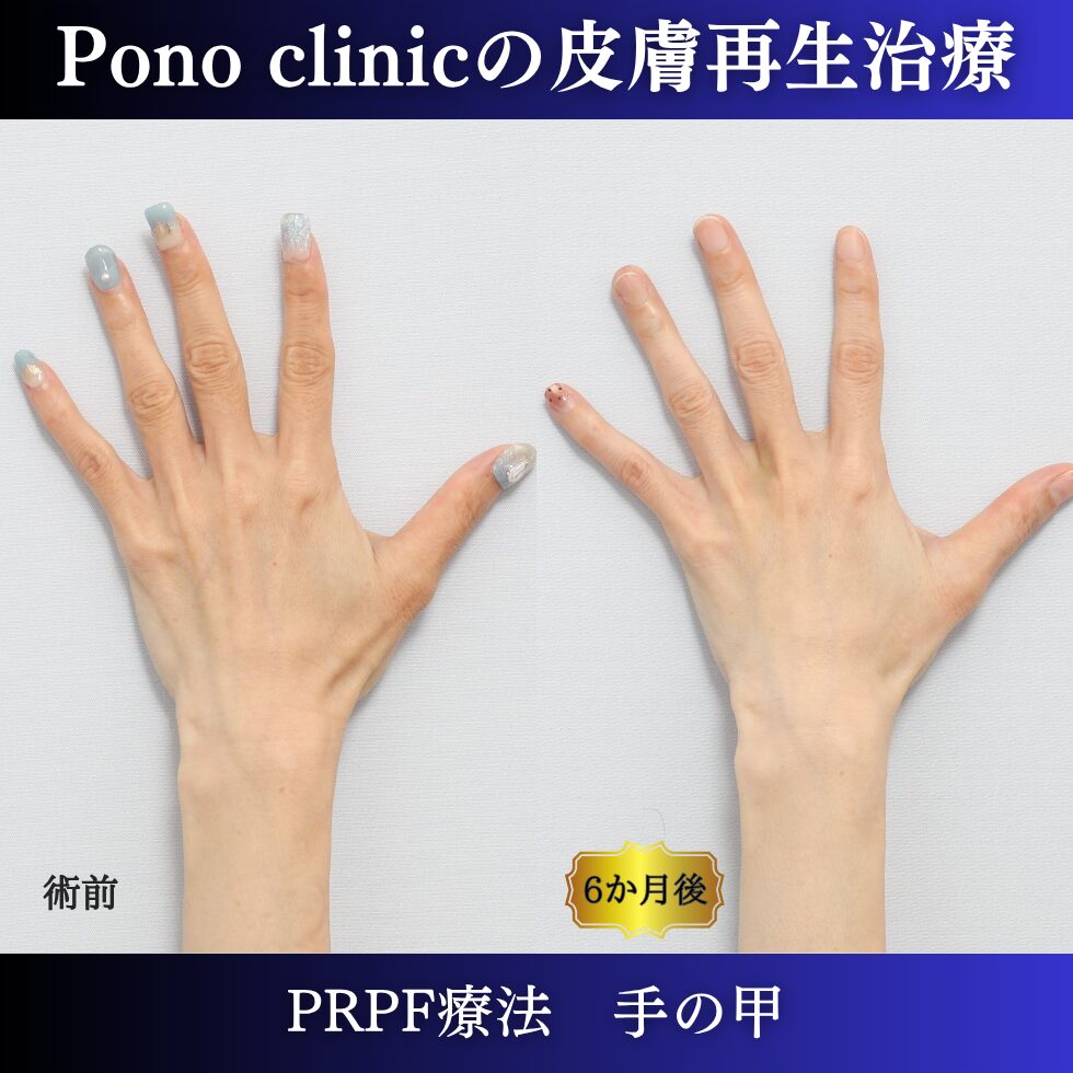 手の甲の若返り、手ののゴツゴツ、PRPF療法 、40代の症例 (3)