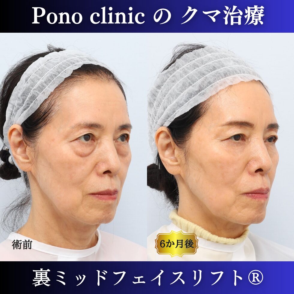 目の下のクマ、目の下のたるみ、裏ミッドフェイスリフト、70代の症例 (1)