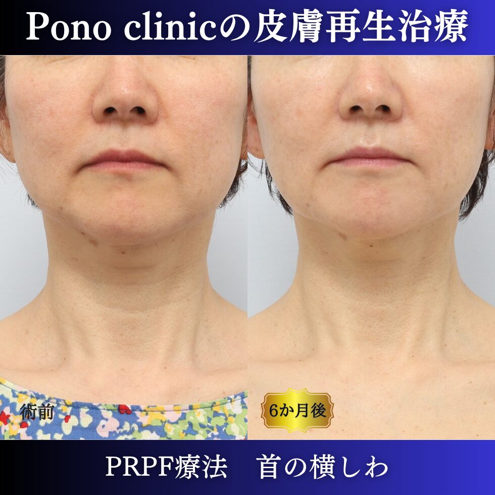 首のシワ、しわ治療、 (7)