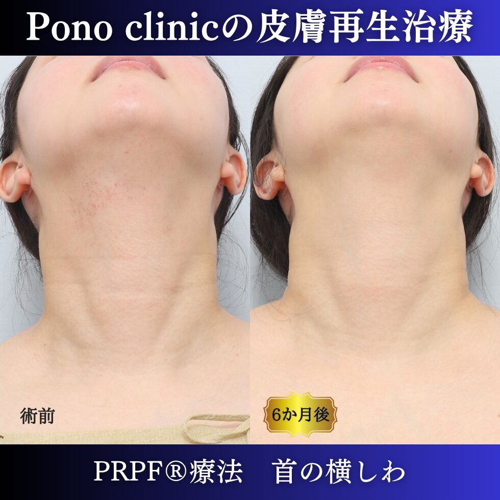 首のしわ、シワ治療、PRPF®療法、30代の症例 (5)