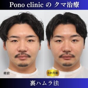 目の下のクマ治療、裏ハムラ法、30代男性の症例 (7)