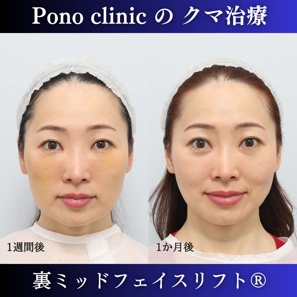 クマ治療、裏ミッドフェイスリフト、裏ハムラ、骨膜下リフト、40代の症例 (1)