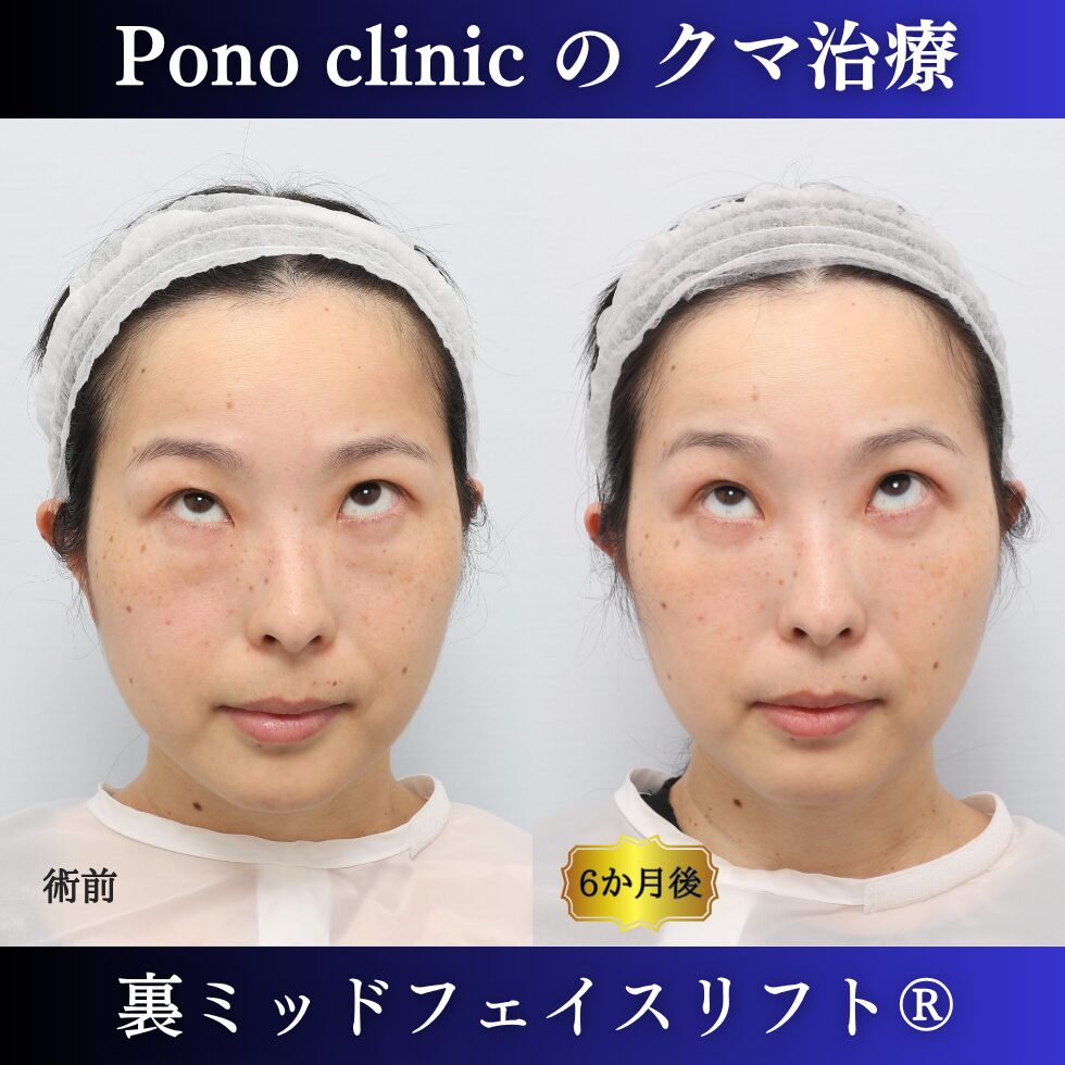 裏ミッドフェイスリフト、裏ハムラ、骨膜下リフト、クマ治療、30代の症例 (3)