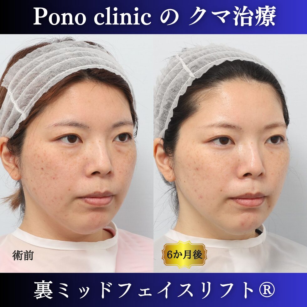目の下のクマ治療、裏ハムラ、骨膜下リフト、裏ミッドフェイスリフト®、30代の症例(2)