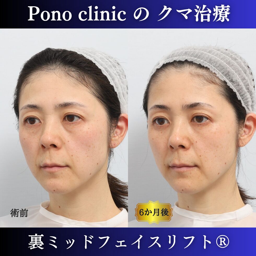 目の下のクマ治療、裏ハムラ、骨膜下リフト、裏ミッドフェイスリフト®、40代の症例 (3)