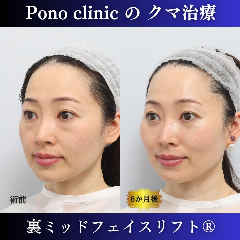 クマ治療、裏ミッドフェイスリフト、裏ハムラ、骨膜下リフト、40代の症例 (3)