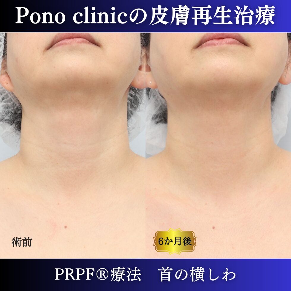 首のしわ、しわ治療、 50代の症例 (3)