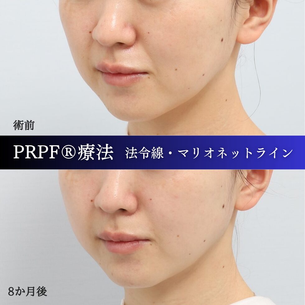 法令線、マリオネットライン、しわ治療、PRPF療法、30代の症例 (2)