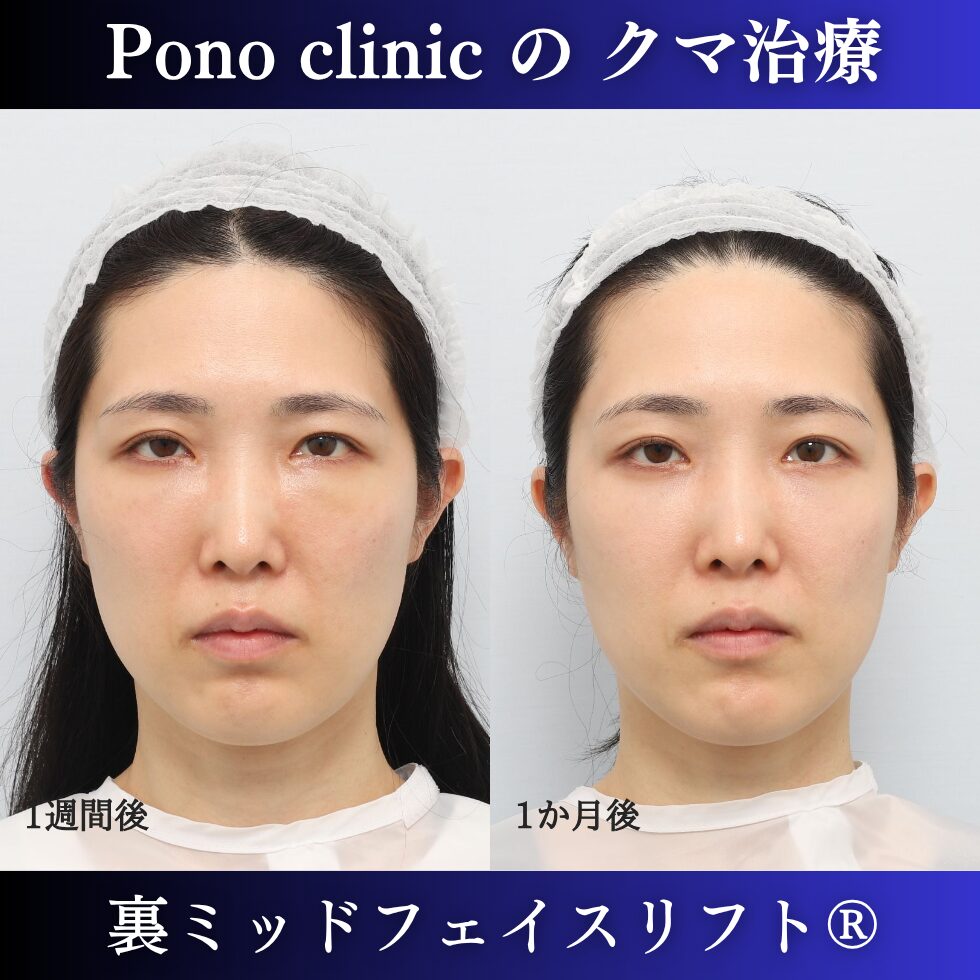 裏ミッドフェイスリフト®、目の下のクマ治療、裏ハムラ、骨膜下リフト、30代の症例 (2)