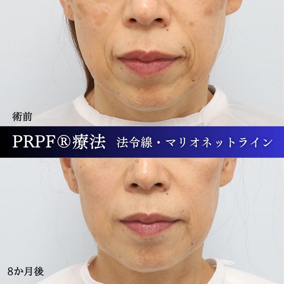 法令線、マリオネットライン、しわ治療、PRPF療法、60代の症例 (3)