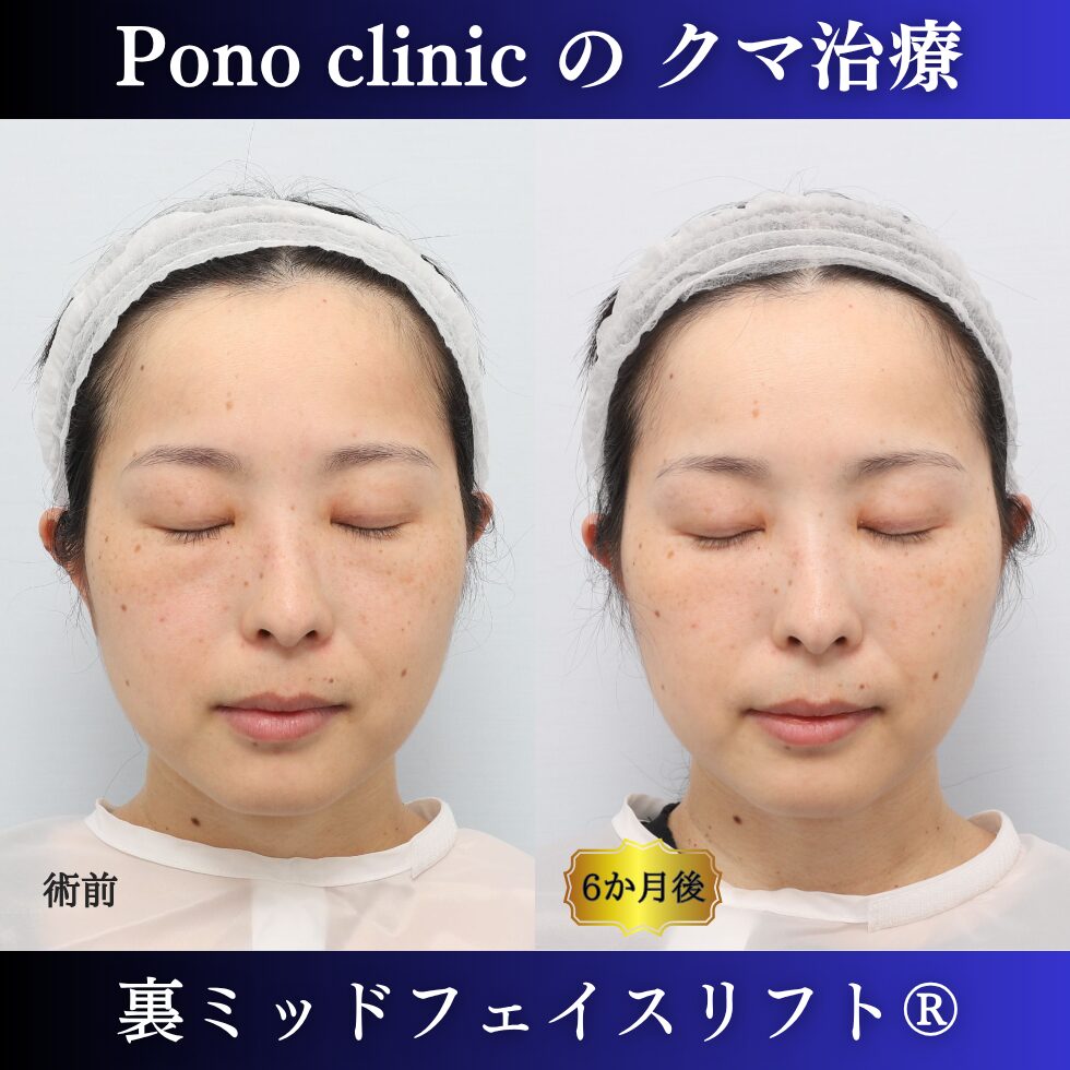 裏ミッドフェイスリフト、裏ハムラ、骨膜下リフト、クマ治療、30代の症例 (6)