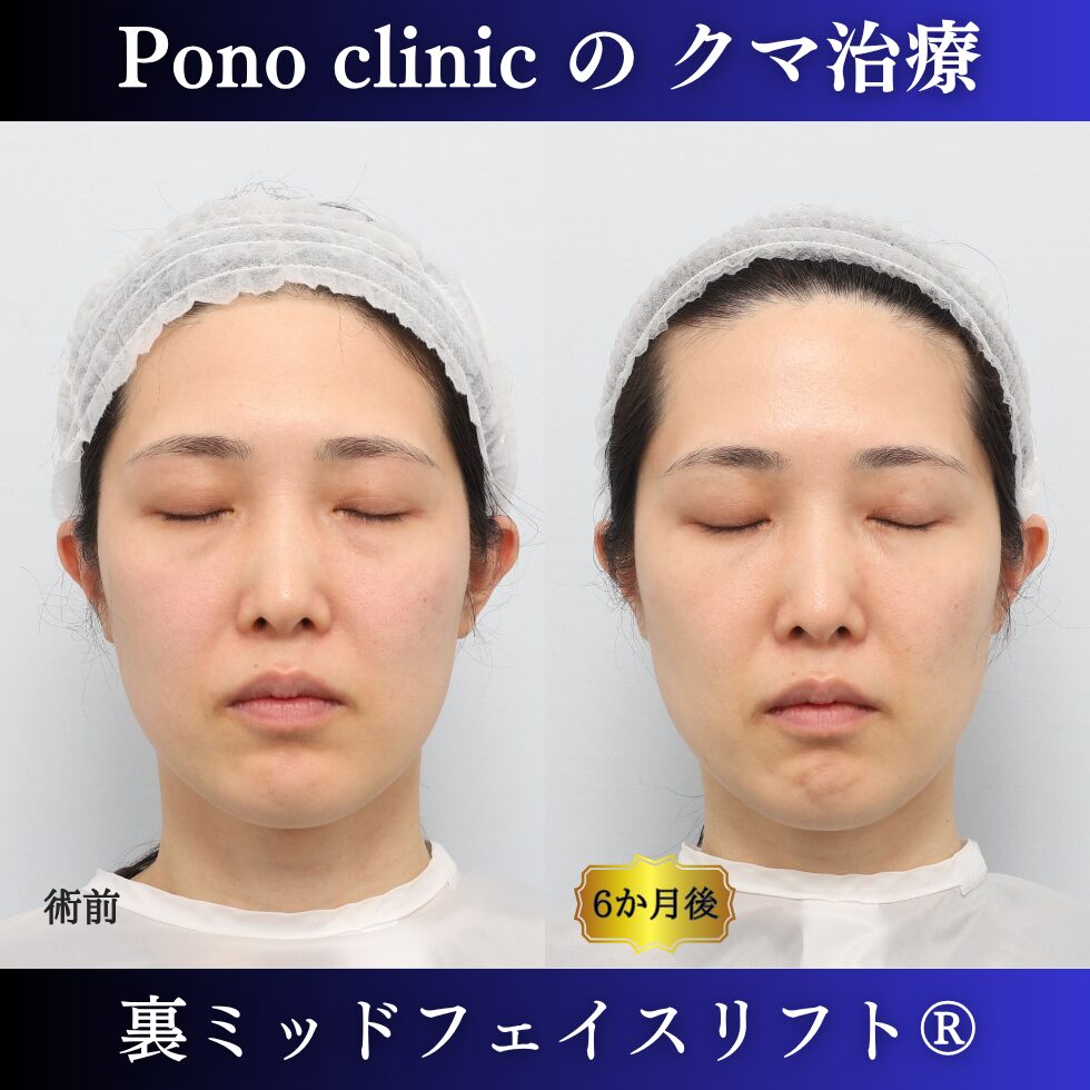 裏ミッドフェイスリフト®、目の下のクマ治療、裏ハムラ、骨膜下リフト、30代の症例 (1)