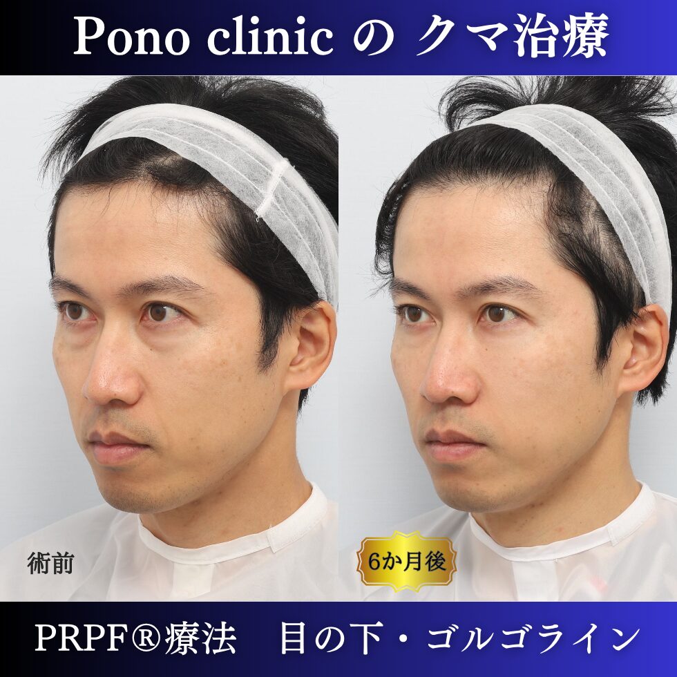 クマ治療、PRPF®療法、目の下、ゴルゴライン、40代男性の症例 (2)
