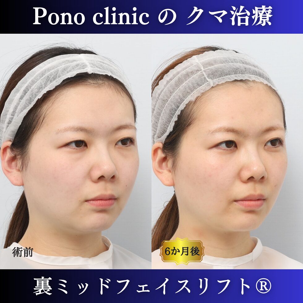 目の下のクマ取り、骨膜下リフト、裏ハムラ、裏ミッドフェイスリフト®、20代の症例 (2)