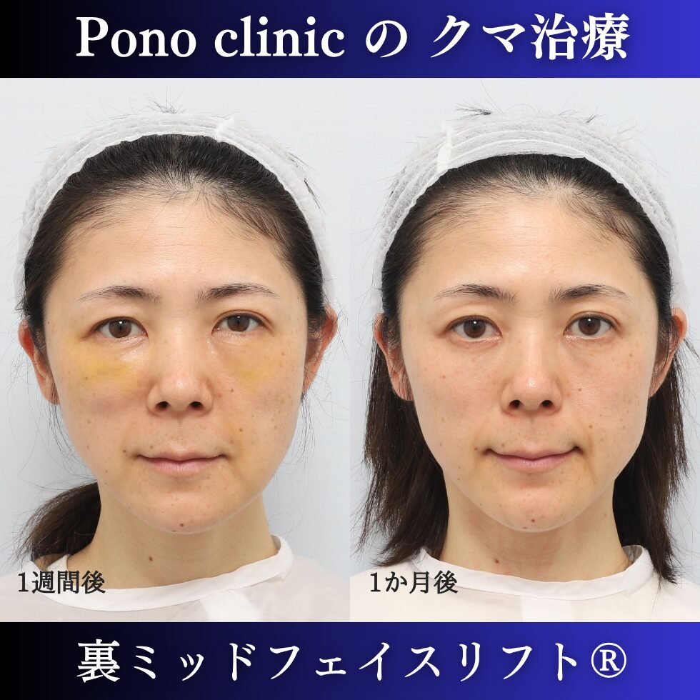目の下のクマ治療、裏ハムラ、骨膜下リフト、裏ミッドフェイスリフト®、40代の症例 (1)