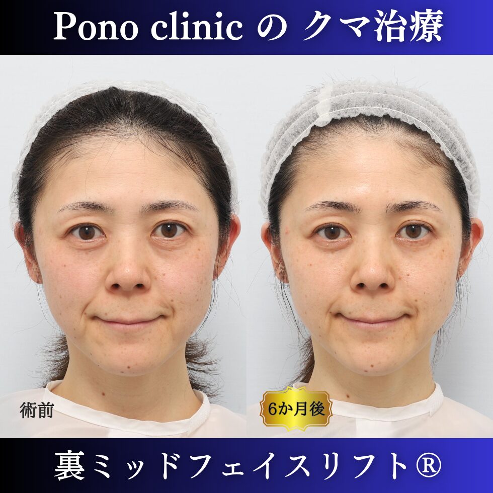 目の下のクマ治療、裏ハムラ、骨膜下リフト、裏ミッドフェイスリフト®、40代の症例 (4)