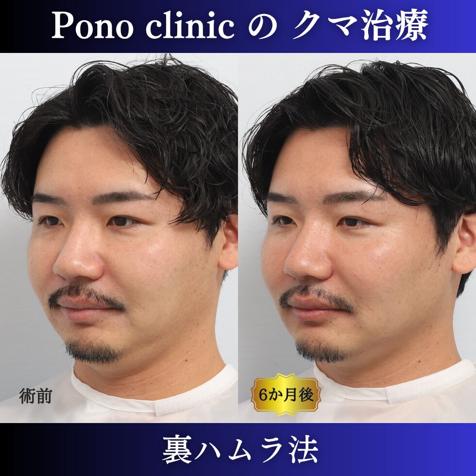 目の下のクマ治療、裏ハムラ法、30代男性の症例 (3)
