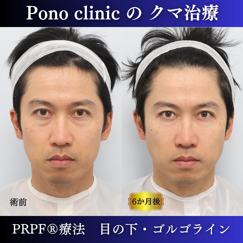 クマ治療、PRPF®療法、目の下、ゴルゴライン、40代男性の症例 (3)